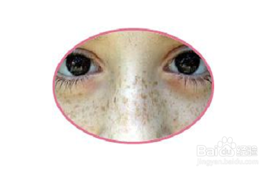 怎么区分晒斑和雀斑