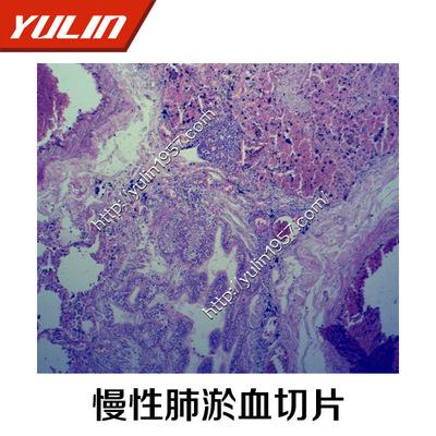 人体病理学显微镜玻片 批发 生物玻片 人慢性肺淤血切片