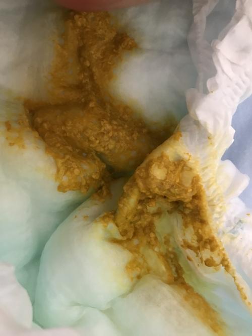 没满月的宝宝一天拉六七次大便,屁屁都插红了.