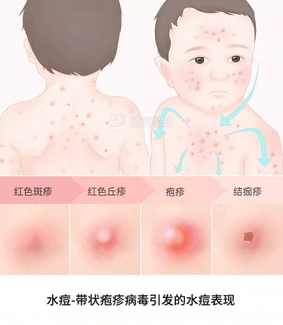 有娃的注意了水痘高发期已杀到快来看看怎么防