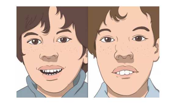 二,日常预防腺样体面容的形成