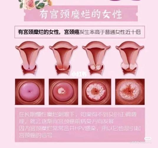 有宫颈糜烂的女性患癌机率比普通人高十倍 有宫颈糜烂
