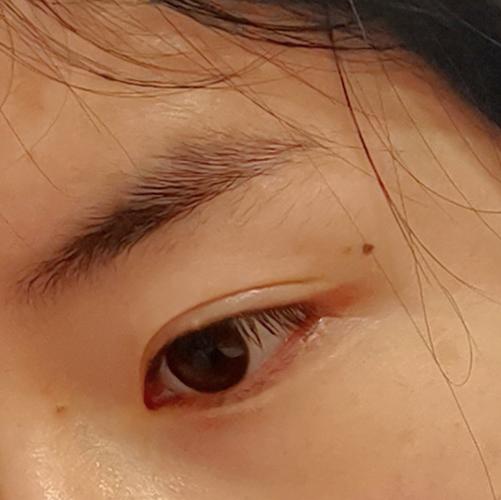 眼皮上的小颗粒