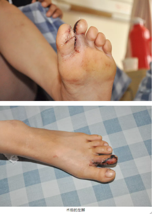 指尖再造,脚趾"变"手指