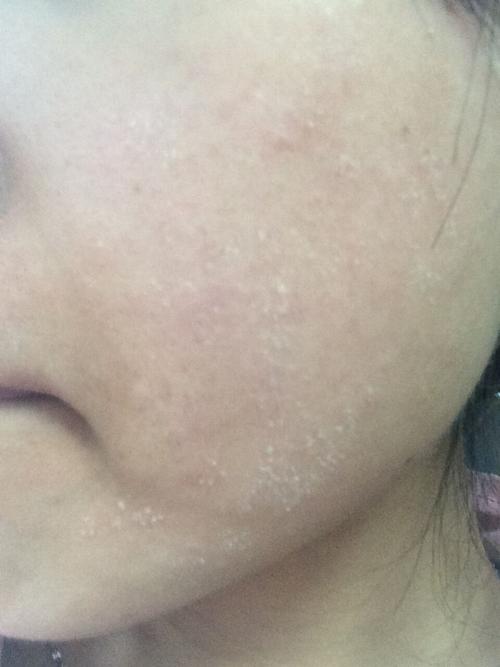 脸上经常蜕皮,这是藓还是干的?搽什么护肤品好?还是涂