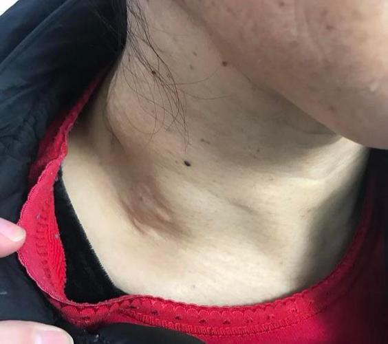 检查出甲状腺结节20年,拖到甲癌淋巴全部转移,包块已经长到颈后