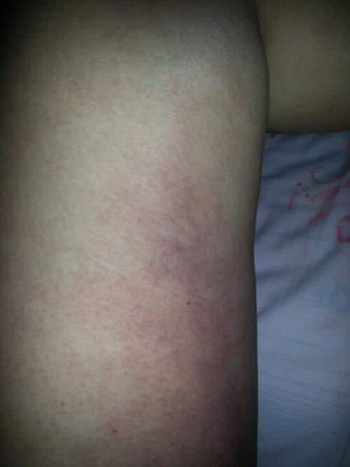 孕后期左右大腿内侧发紫,刚刚发现的,怎么回事儿?没同样情况的