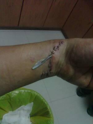 我手腕中间在工作中不小心被刀尖插到,动了