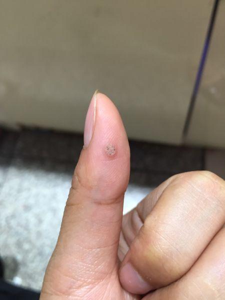 大拇指长了个凸起的硬疙瘩,剪平后会再长出来,是什么?