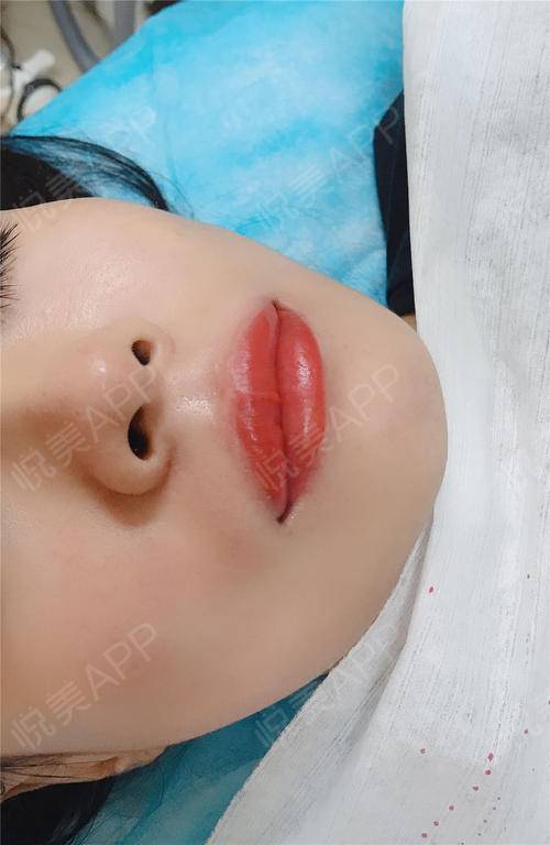 半永久纹唇术后1天_半永久化妆术后1天_皮肤美容术后1天_月影无踪分享