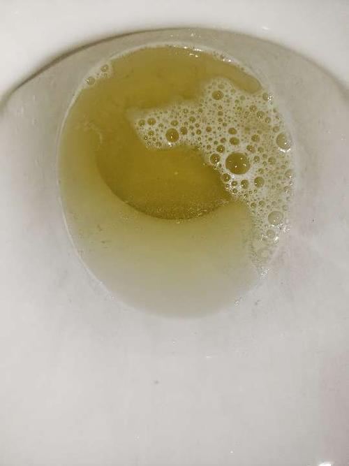 尿液浑浊,泡泡多