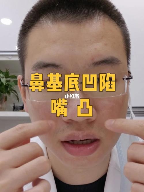 鼻基底凹陷,嘴凸._北京攻略_鼻基底_美妆_医美整形