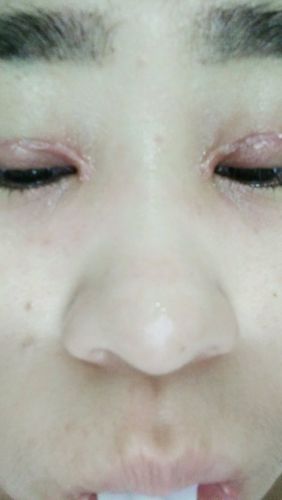 双眼皮术后疤痕增生图