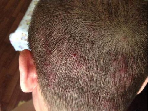 头皮上脂溢性皮炎和毛囊炎共生,多年,你们有根治的么?