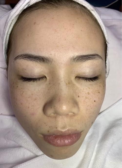 满脸的遗传性雀斑,真的是满脸plus——有图慎点!做了一次超皮,来汇报!