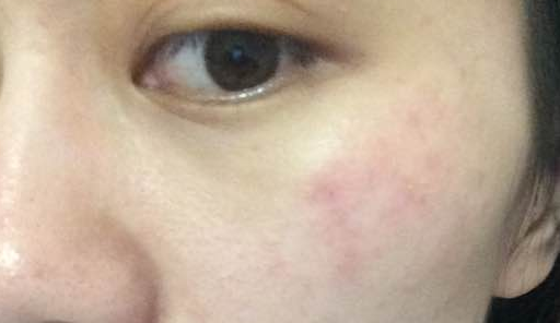 手机辐射过敏的症状 发生过敏反应的病因