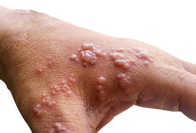 皮肤出现这3个特征,小心是胃癌的信号