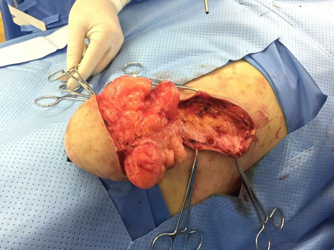 巨大脂肪瘤切除