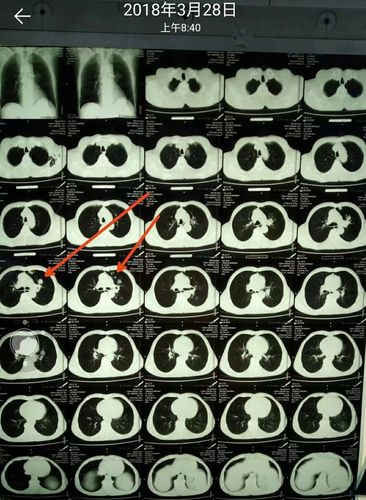 是烟龄长的男性同胞,不要单一的想到炎症,结核这些"友善"(愈合好)疾病