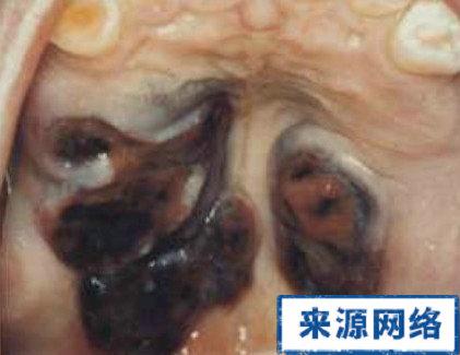 艾滋病口腔症状图片大全(三):卡波式肉瘤