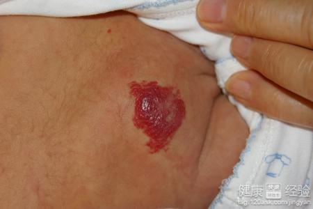 胸部有血管瘤严重吗