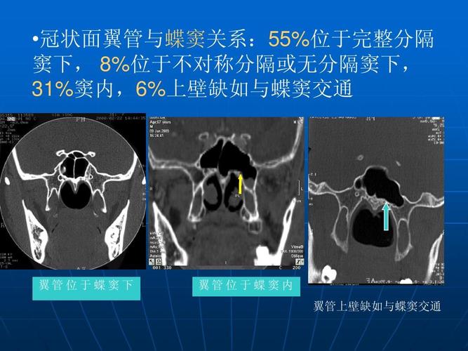 窦完, 8下%位于对称分不或无分隔窦下,隔31 %内窦6,%壁上如缺与蝶窦