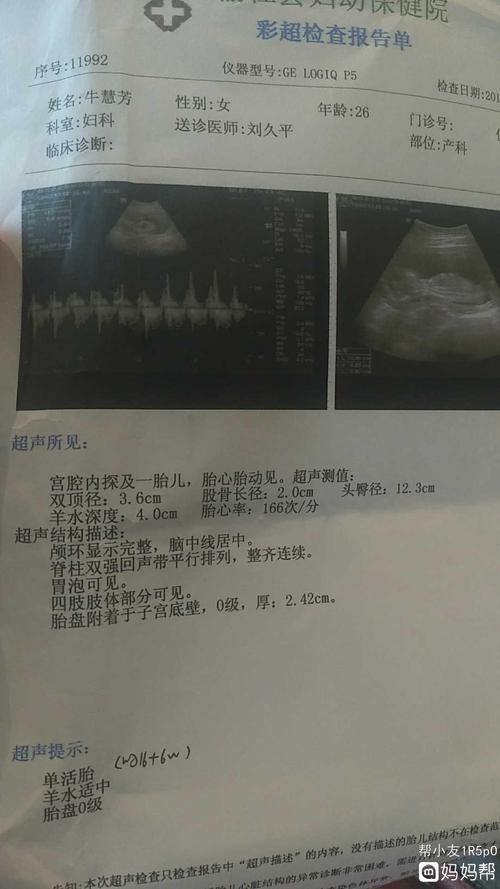 根据双顶径和胎心率怎么看男宝还是女宝