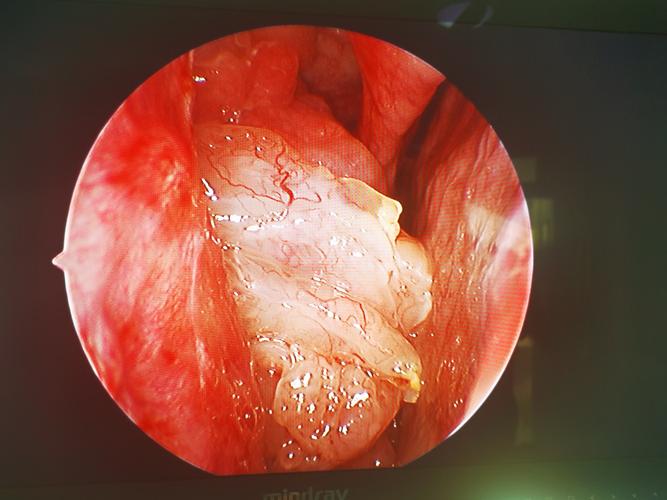 重度鼻中隔偏曲