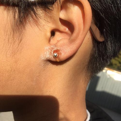 耳洞连续发炎2星期了 到现在还没有好 今天去做过山车