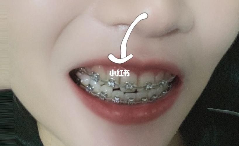 牙套_补牙_美妆_医