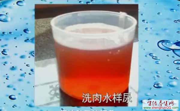 洗肉水样尿可能预示 肿瘤,结石,细菌感染,肾小球肾炎.