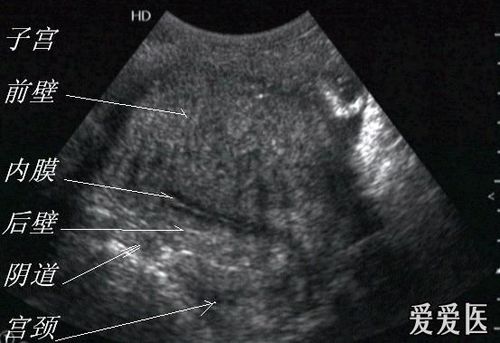 子宫腺肌症 - 超声医学讨论版 - 爱爱医医学论坛