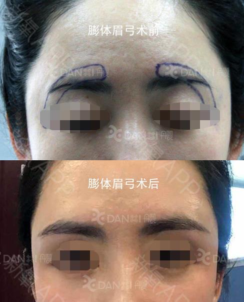 假体丰眉弓术前,术后3个月;丰眉弓除了增加上面部立_圈子-新氧美容