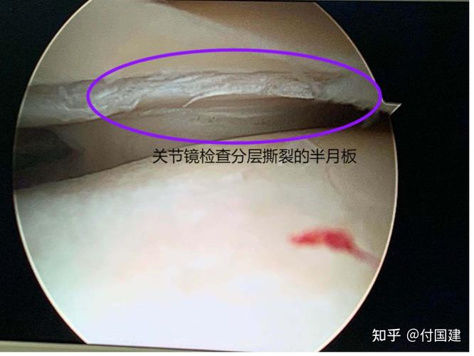 半月板后角撕裂常见的症状有哪些