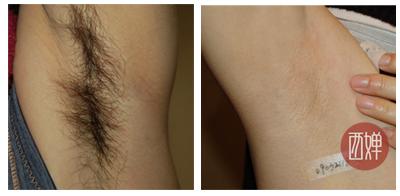 激光脱腋毛前后对比