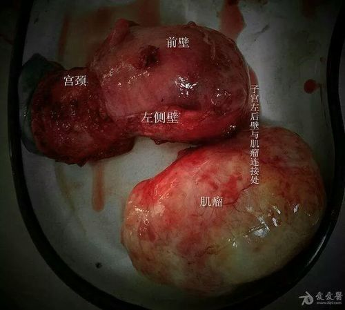 切除子宫的女人!你认为不需要保养妇科了吗