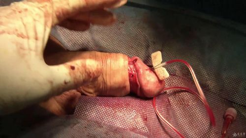 国外海绵体麻醉包皮环切