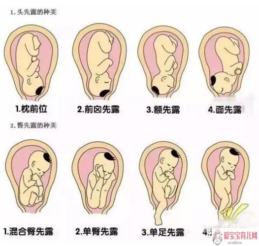 是异常胎位中最常见的一种,孕妈妈在妊娠6~7个月的时候若是臀位,可在