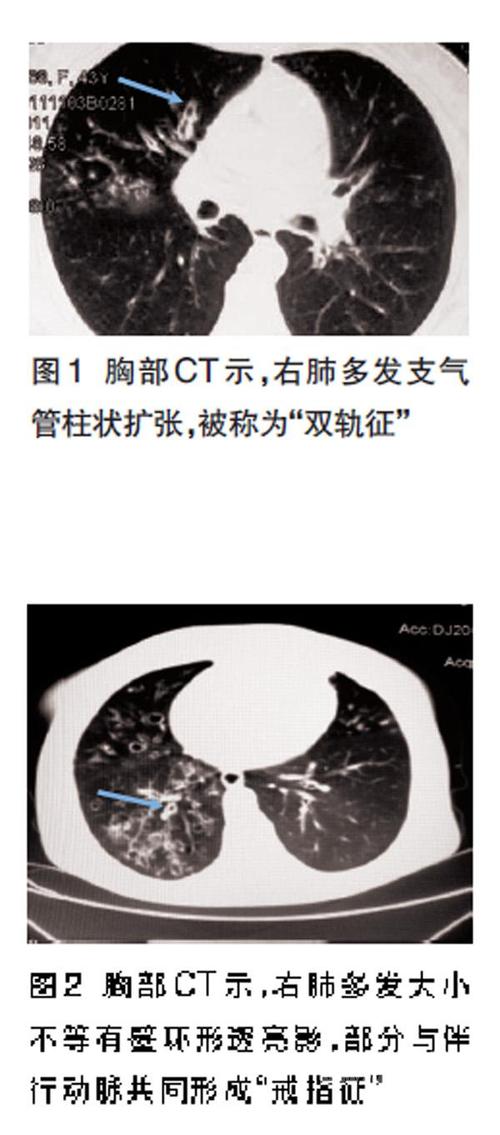 支气管扩张的ct检查表现