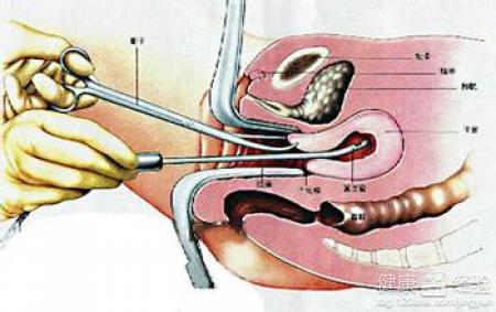 双腔减压无痛人流过程