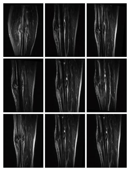 左小腿磁共振显示骨折端无明显炎症信号.