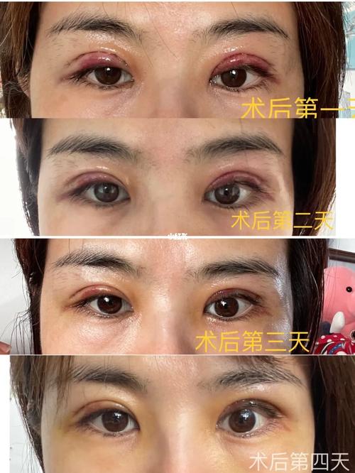 双眼皮加单侧提肌手术_双眼皮_美妆_医美整形
