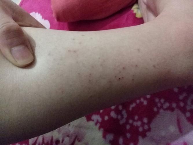 去美容院小腿部位脱毛,第二次脱完后,小腿开始起红点,后来变成这样,看