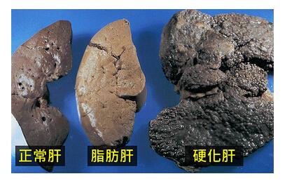 中间的肝细胞里面含有圆形大颗的空泡就是脂肪,右边则是硬化的肝