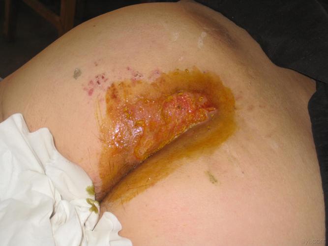 两个皮肤溃疡病人