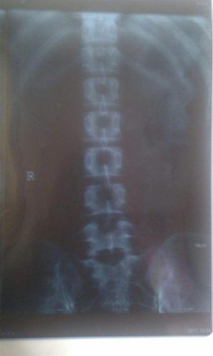 骶骨裂是怎么回事