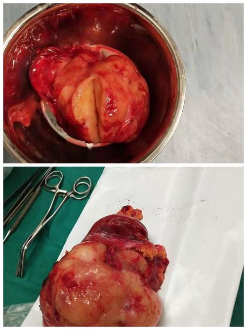 胃癌根 写美篇 患李莫,上腹部疼痛1月,ct左上腹部巨大肿块