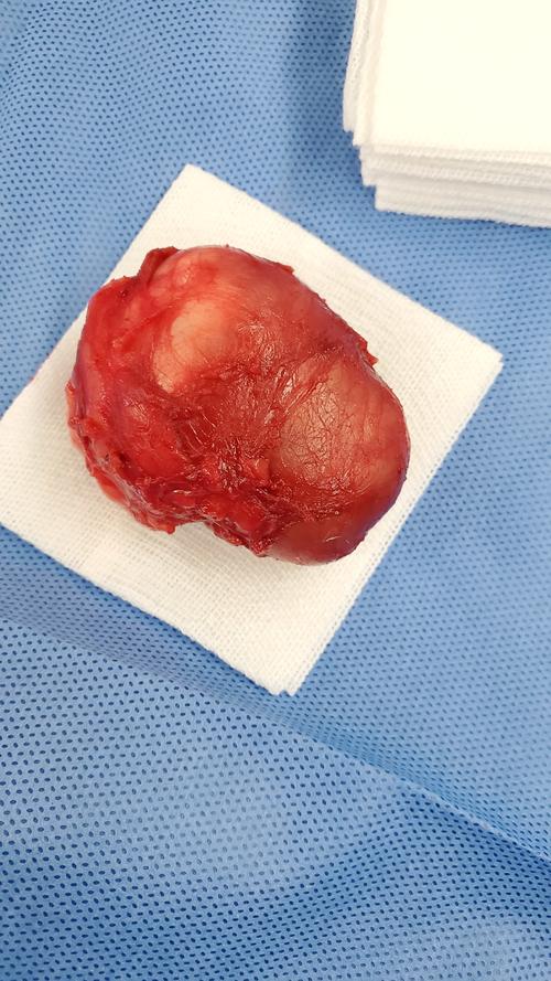 分享一例臀部皮脂腺囊肿病例