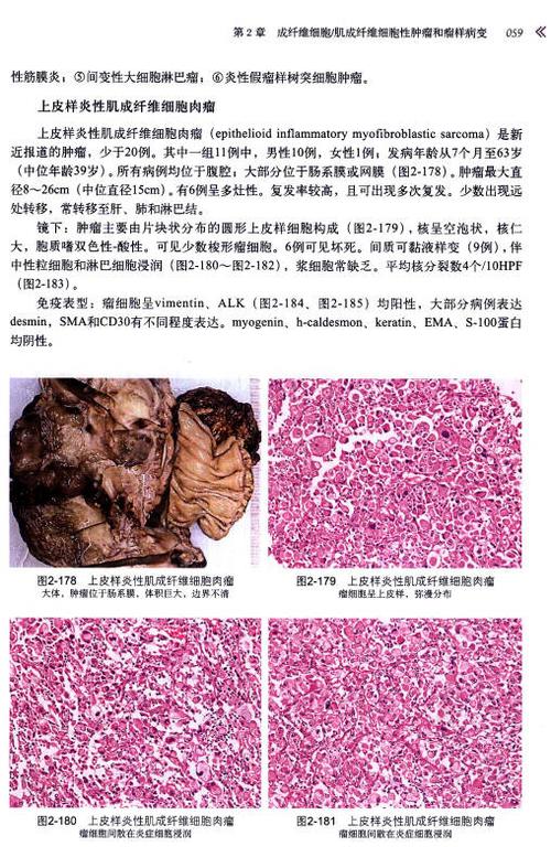 软组织肿瘤病理学诊断图谱