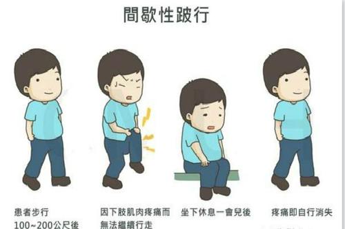 间歇性跛行或是腰椎管狭窄症